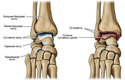 Osteoartrita simptomelor si tratamentului extremelor inferioare