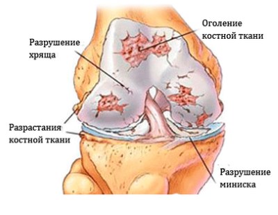 Osteoartrita simptomelor si tratamentului extremelor inferioare