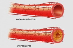 Ateroscleroza vaselor de la nivelul extremităților inferioare tratate cu remedii folclorice