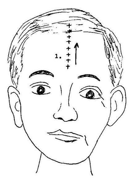 Ayurveda accident vascular cerebral - tratament cardiac