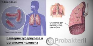 Bacteria tuberculozei cât de mulți trăiesc agentul cauzal al bolii