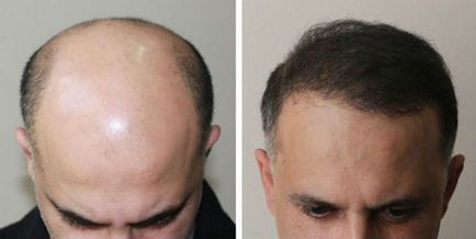 Biotin haj (fotó előtt és után)