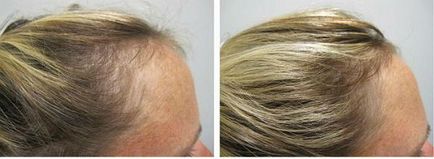 Biotin haj (fotó előtt és után)
