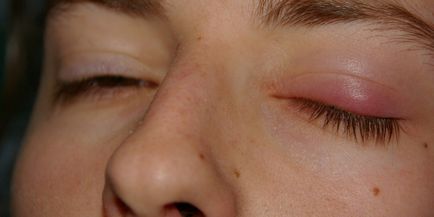 Pleoapa dureaza peste ochi, ce sa faca atunci cand pleoapa superioara este umfla si doare, motivele si modul de tratament