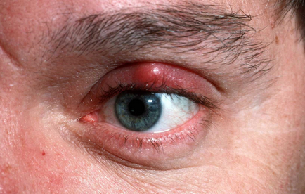 Болить повіку над оком, що робити коли опухло верхню повіку ока і болить, причини і спосіб лікування