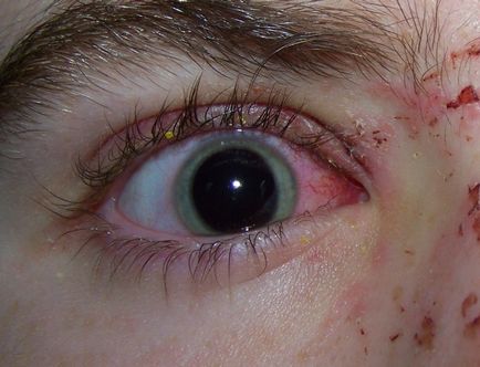 Болить повіку над оком, що робити коли опухло верхню повіку ока і болить, причини і спосіб лікування