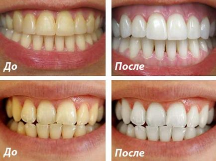 Metode și mijloace de albire a dinților prin auto-vindecare