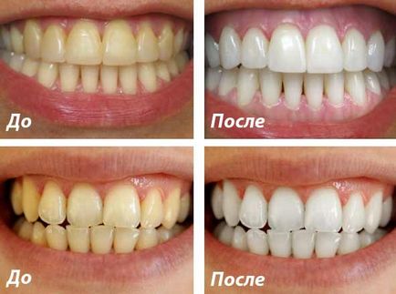 Camostoyatelnoe fogfehérítés módszereket és eszközöket
