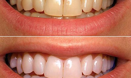 Metode și mijloace de albire a dinților prin auto-vindecare