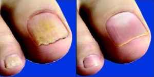 Чим краще лікувати грибок нігтя або ще поради