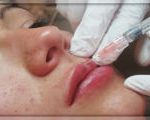 Через скільки днів спаде набряк після збільшення губ гіалуроновою кислотою, гіалуронова кислота