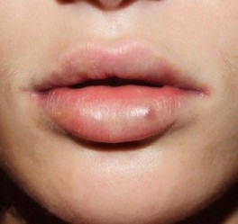 Umflarea după acid hialuronic augmentarea buzelor