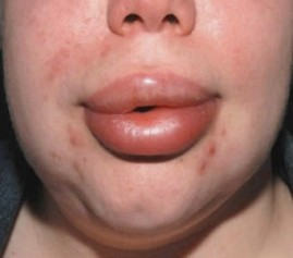 Через скільки днів спаде набряк після збільшення губ гіалуроновою кислотою, гіалуронова кислота
