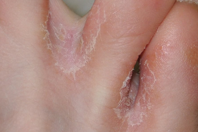 Що робити, якщо лущиться шкіра між пальцями ніг, нарости на шкірі