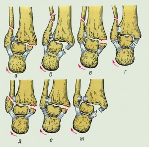 Ce să faceți dacă întindeți ligamentele pe braț