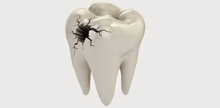 Ce se face cu un prejudiciu dinte - dislocare, vânătăi, fractură ~ stomatologie Izhevsk