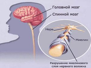 Care este optiocciolitul diavolului descrierea bolii, simptome, simptome și tratamentul bolii diavolului