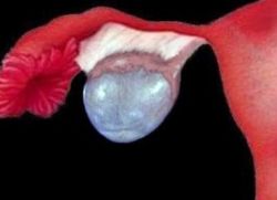 Cystadenomul ovarului stâng