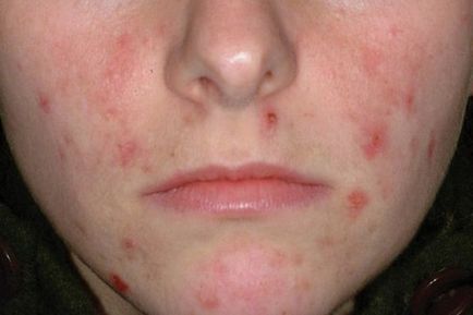 Демодекс лікування, фото на обличчі кліща і симптоми