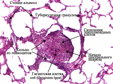 Efectul tuberculozei asupra corpului (patomorfologie), eurolab, bolile infecțioase