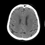 Dinamica accidentului vascular cerebral (infarct), un portal al radiologilor