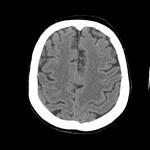 Dinamica accidentului vascular cerebral (infarct), un portal al radiologilor