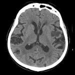 Dinamica accidentului vascular cerebral (infarct), un portal al radiologilor