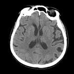 Dinamica accidentului vascular cerebral (infarct), un portal al radiologilor