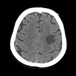 Dinamica accidentului vascular cerebral (infarct), un portal al radiologilor