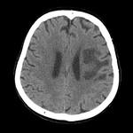 Dinamica accidentului vascular cerebral (infarct), un portal al radiologilor