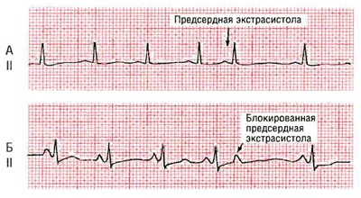 Korai pitvari ütések EKG tünetei és típusai