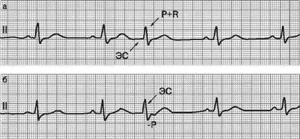 Korai pitvari ütések EKG tünetei és típusai