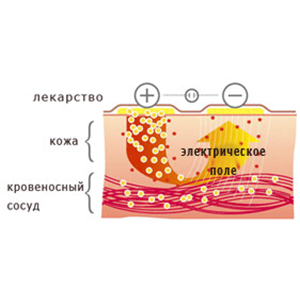 Електрофорез при остеохондрозі