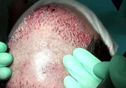 Etape de restaurare a părului chirurgical - cosmetologia Rusiei