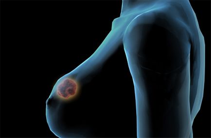 Fibroidadenoma glandă mamară tratamentul popular și chirurgie pentru a elimina