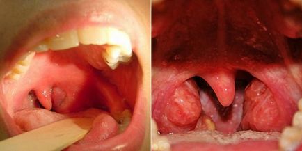 Amigdalita amigdalită în simptome de formă acută pe fotografie, tratamentul bolii