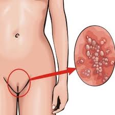 Herpesz a menstruáció alatt