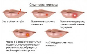 Герпес при місячних