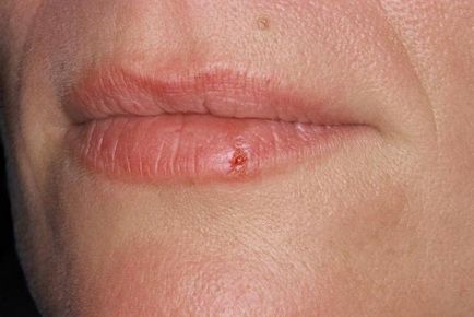 Herpes pszichoszomatikus betegségek