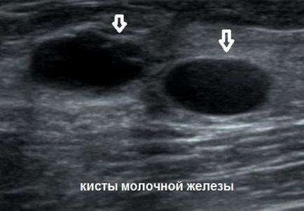 Formarea hipoechoică în glanda mamară ce este, cauze, simptome, tratament