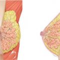 Formarea hipoechoică în glanda mamară ce este, cauze, simptome, tratament