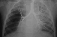 Tüdő- hypoplasia - okai, tünetei, diagnózisa és kezelése