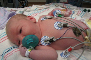 Гіпоплазія легенів у новонароджених дітей симптоми, лікування гіпоплазії правого і лівого легкого