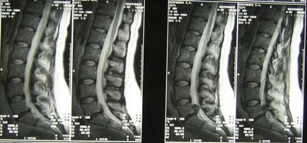 Discuri herniate