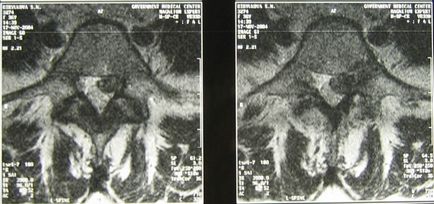 Discuri herniate