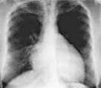 Miocardită idiopatică a abramului - cauze, simptome, diagnostic și tratament