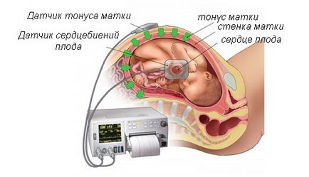 Imunoglobulina în timpul sarcinii cu Rhesus negativ este o aplicație, bine!