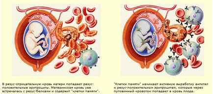 Imunoglobulina în timpul sarcinii cu Rhesus negativ este o aplicație, bine!