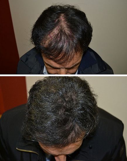 Implantarea elementelor artificiale de păr, operație, îngrijire