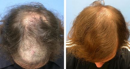 Implantarea elementelor artificiale de păr, operație, îngrijire